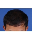 After Hair Transplant&nbsp;2 Sessions (Areas)